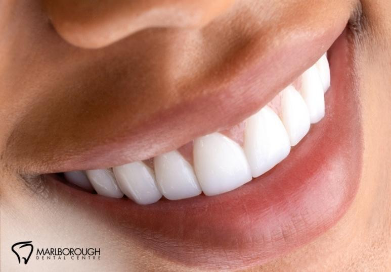 How to Keep Your Teeth White After a Professional Whitening Treatment